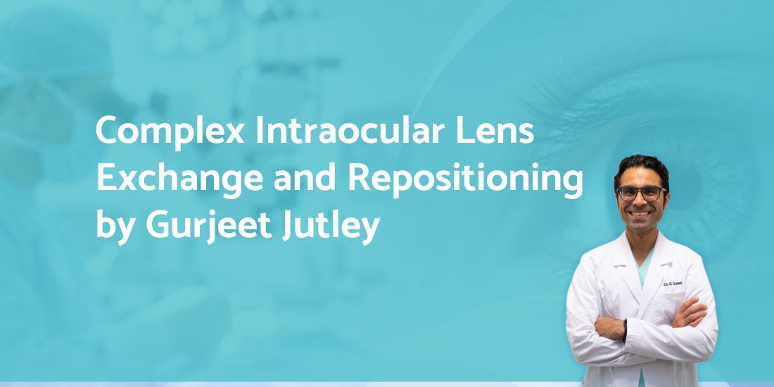 Complex Intraocular Lens Exchange and Repositioning by Gurjeet Jutley